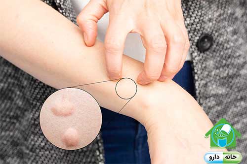 ویتامینهای مورد نیاز جهت جلوگیری از خارش بدن