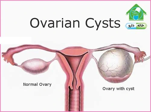 خرید آنلاین دارو و مکملهای دارویی با ارسال سریع - بهترین دارو برای کیست تخمدان درمان کیست تخمدان