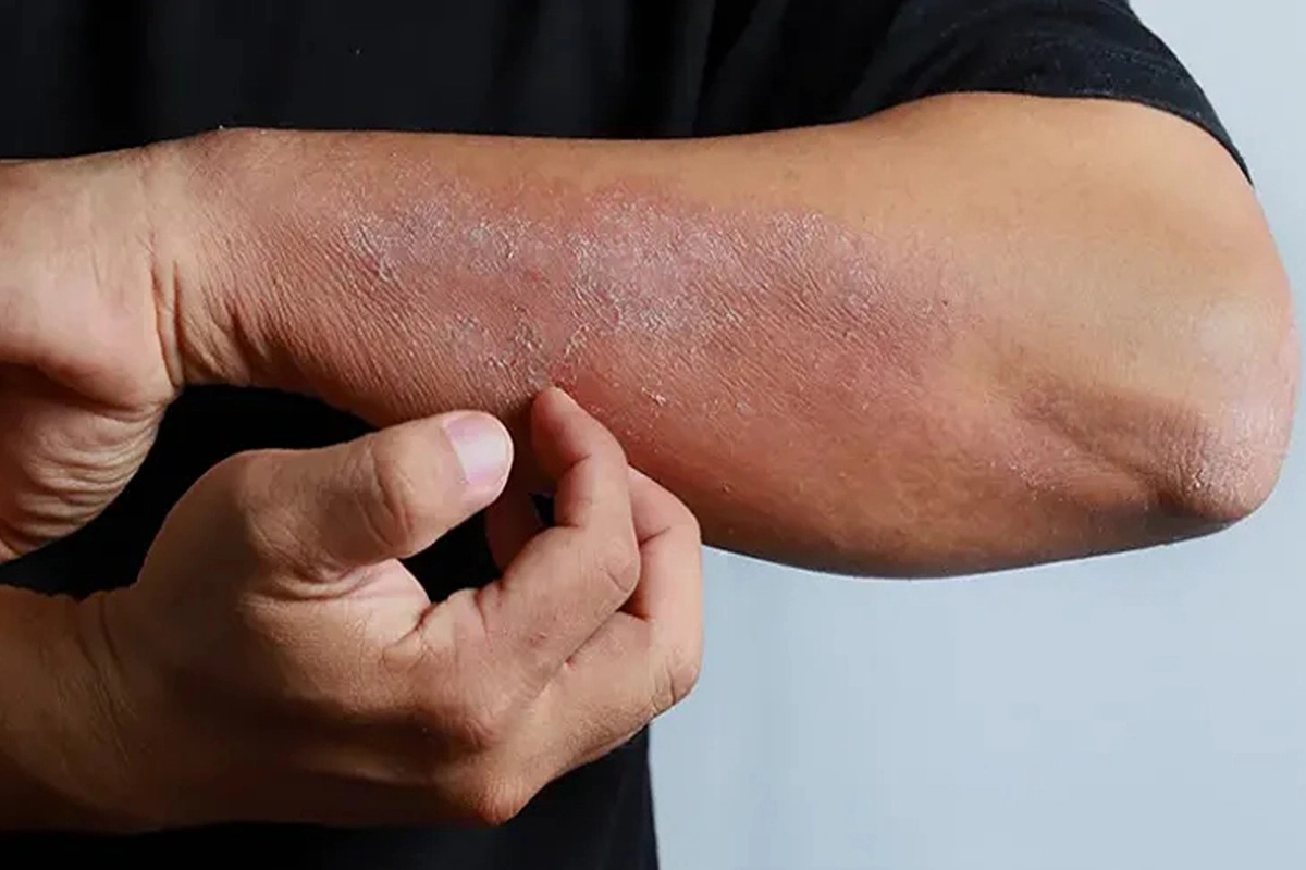 داروهای هومیوپاتی برای اگزما