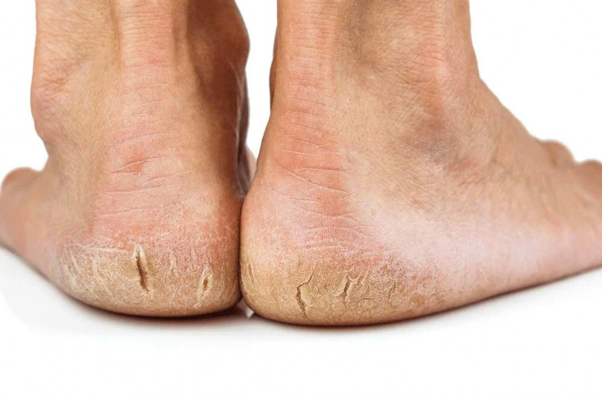 خرید آنلاین دارو و مکملهای دارویی با ارسال سریع - درمان سریع ترک پا چیست؟ علل ایجاد ترک پا